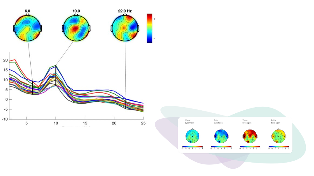 Mapa cerebral EEG mostrando actividad eléctrica en diferentes regiones del cerebro durante una evaluación de TDH.
