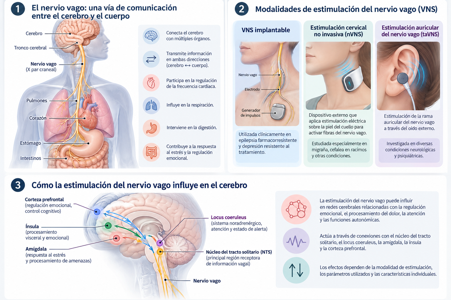 Infografía científica en español sobre el nervio vago: conexión cerebro-cuerpo, VNS implantable, estimulación cervical no invasiva y auricular, y vías cerebrales relacionadas con regulación autonómica.